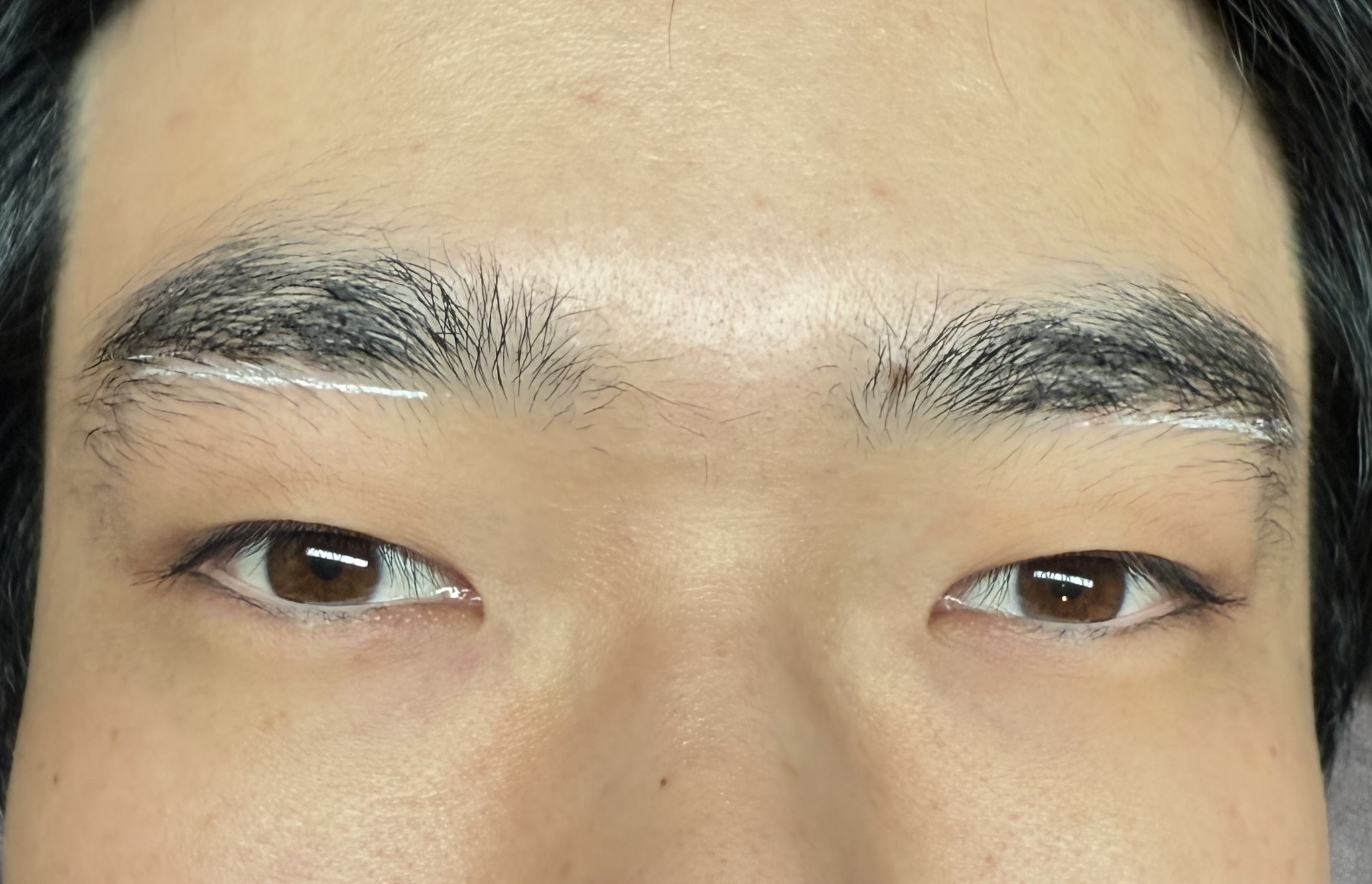 眉毛の美容電気脱毛施術前