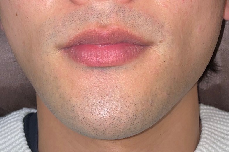 あご脱毛[Before]