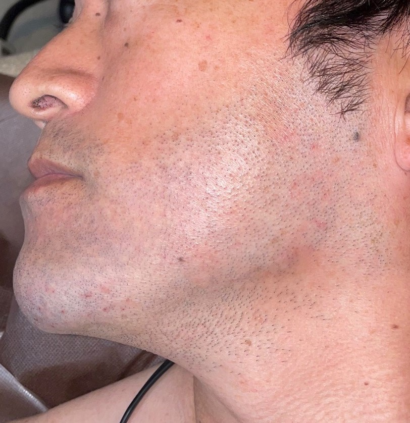 ひげ全体脱毛 13回照射[Before]