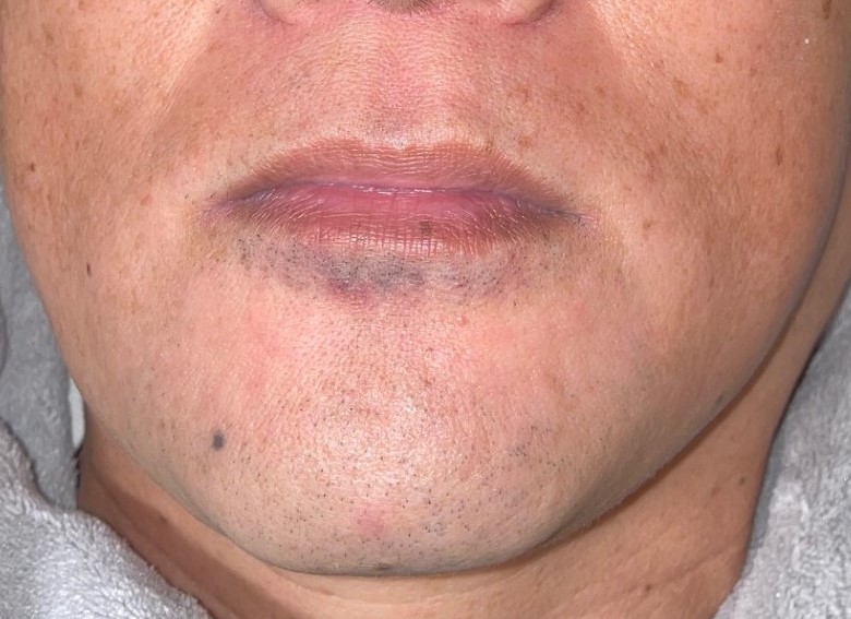 ひげ全体脱毛 13回照射 [After]