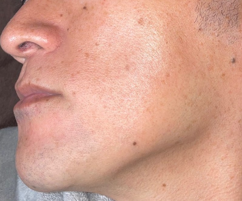 ひげ全体脱毛 13回照射[After]