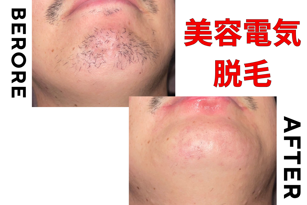 美容電気脱毛（ニードル脱毛）の圧倒的な効果