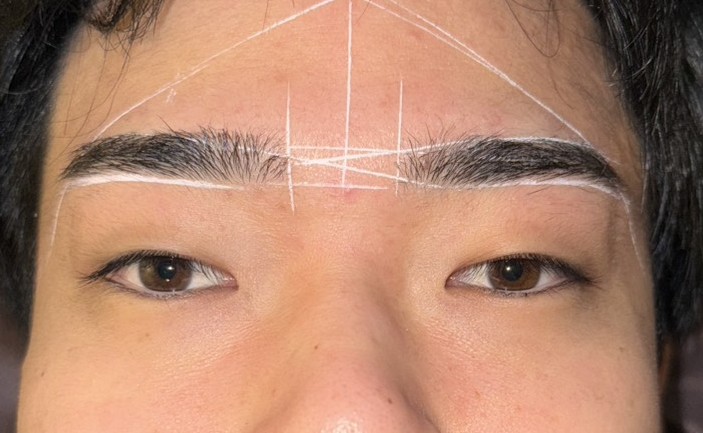 眉毛美容電気脱毛　5回